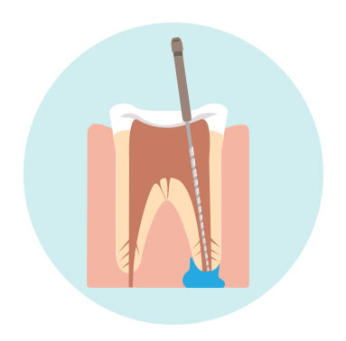 sideimage-rootcanal sideimage-rootcanal