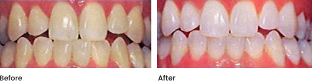 cs-teeth-whitening