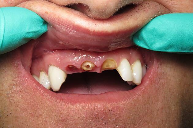 Dental Implant Crowns_CaseStudy_Before