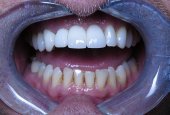 Dental Implant Crowns_CaseStudy_After