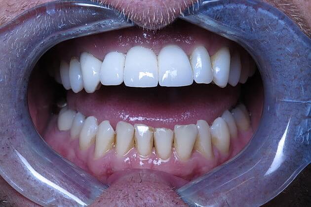 Dental Implant Crowns_CaseStudy_After