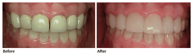 dental-crown-case-study-before-and-after-park-dental