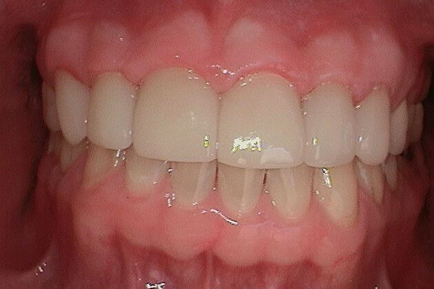 dental-crown-after-park-dental