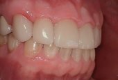 dental-crown-before-and-after-park-dental