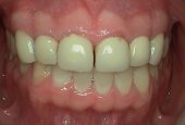 Dental-crown-before-and-after-park-dental